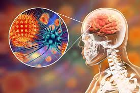 Encephalitis